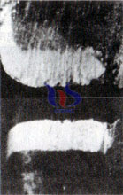 cemented carbide tool wear